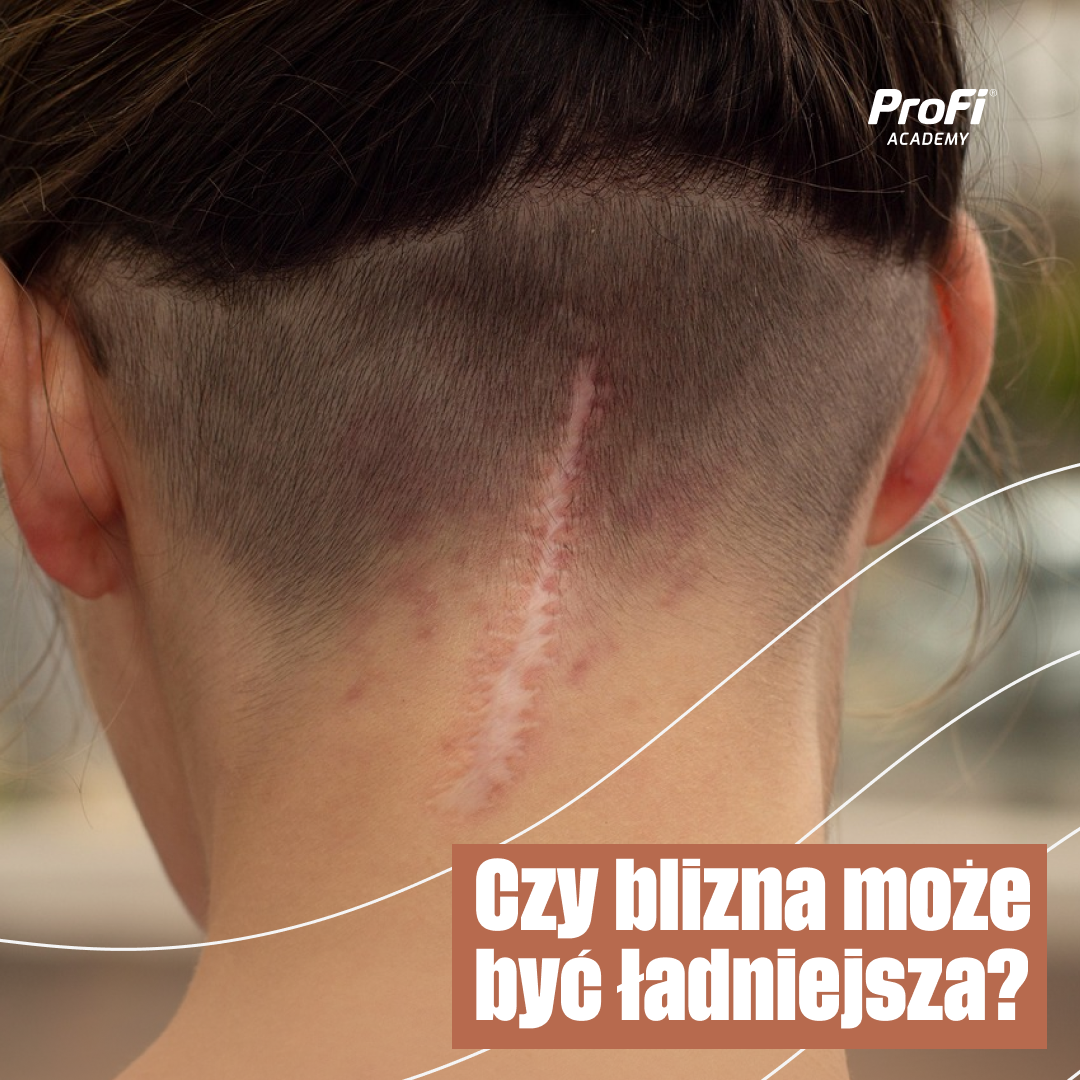  Czy blizna może być ładniejsza?