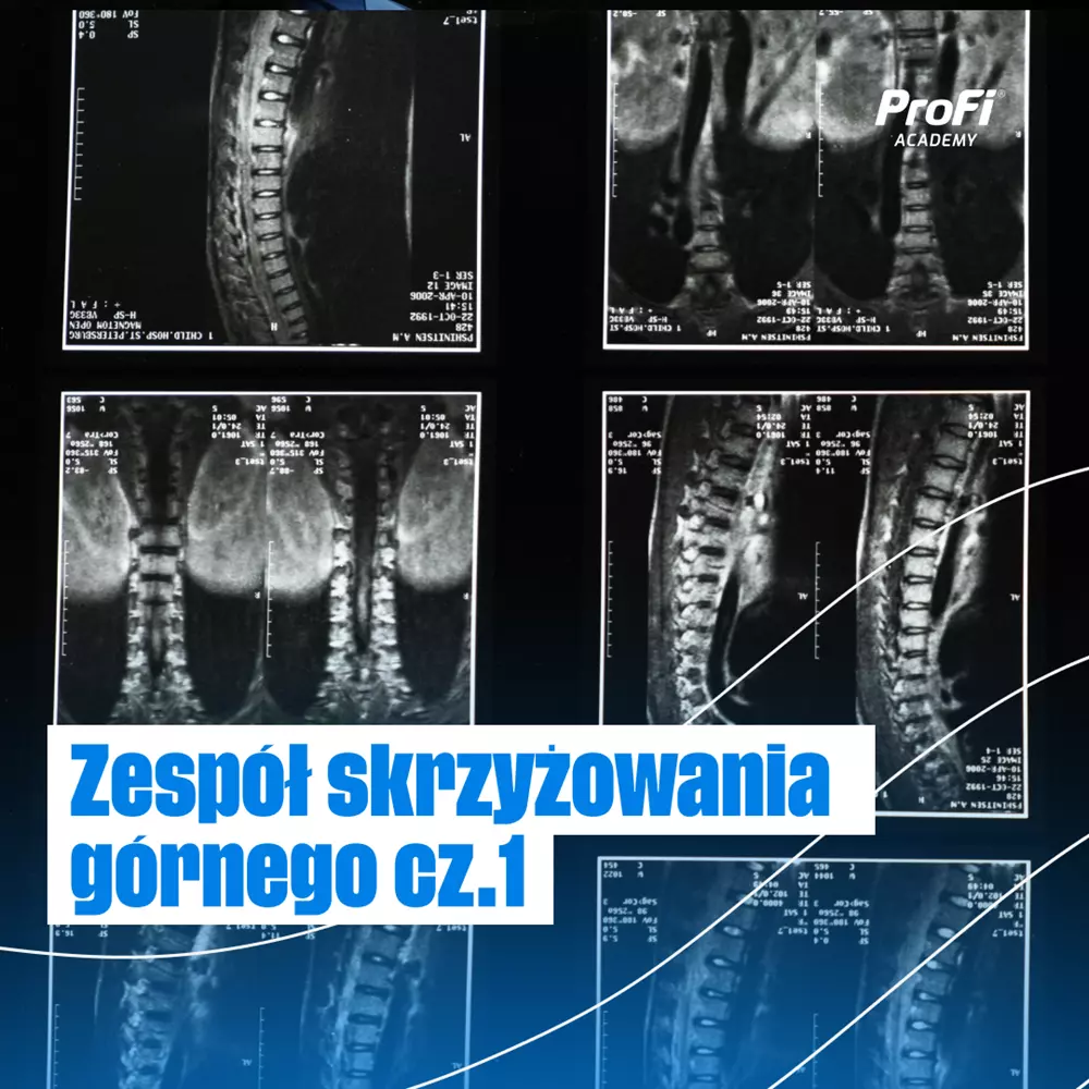 Zespół skrzyżowania górnego cz.1